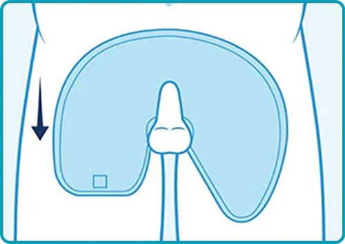 Retracted Penis Application Instructions