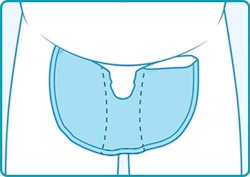 Bariatric / Hidden Penis Application Instructions