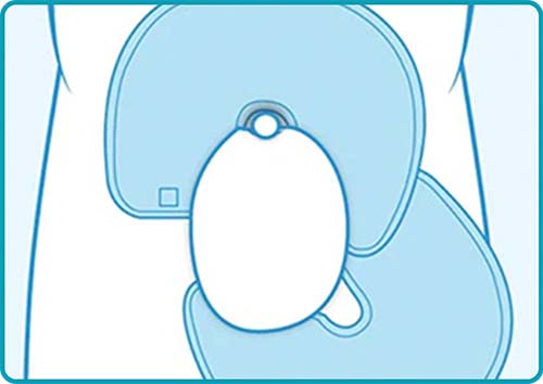 Scrotal Edema (2 Wraps) Application Instructions